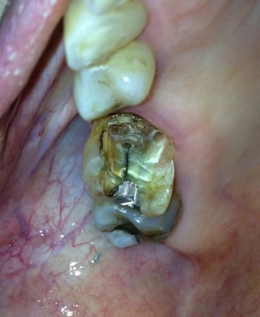 Tooth # 3 Had a Big MOD Amalgam Filling for years,Stresses Caused a MD Crack Extending Down To Root. Photo By Dr Ismail.