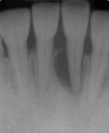 Mandib.Central Incisor With A 10 mm Period. Pocket on Mesio Lingual & Grade 2 Mobility, No Signs Of Endodontic Origin. Poor Prognosis.