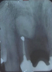 Final x-ray showing the bone graft filling the cyst cavity.